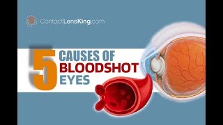 Bloodshot Eyes  5 Causes of Bloodshot Red Eyes [upl. by Schroder162]