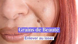 Retirer un grain de beauté au laser chez Skin Marceau [upl. by Sadira]