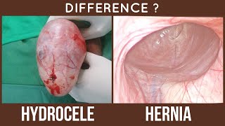 HYDROCELE vs HERNIA  Difference [upl. by Theo207]