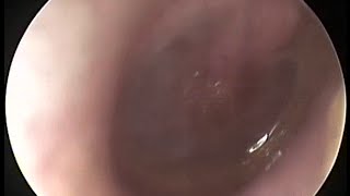 ASOM  Pus inside eardrum   Cause of ear pain in child due to common cold [upl. by Ymerej872]