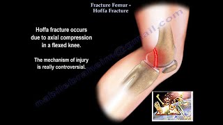 Fracture Femur Hoffa Fracture  Everything You Need To Know  Dr Nabil Ebraheim [upl. by Ilrebmik894]