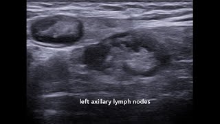 Axillary Lymphadenopathy Ultrasound Case 1 [upl. by Nerrol]