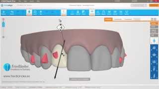 Invisalign ClinCheck Pro Tutorial espaciado con stripping  Ortodoncia Friedländer Barcelona [upl. by Zeta397]