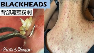 背部黑頭粉刺blackheads on back  Taiwan Tainan台南清粉刺最乾淨 [upl. by Elleirb692]