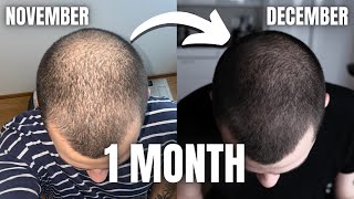 FINASTERIDE MINOXIDIL amp DERMA ROLLING 2 MONTHS INSANE RESULTS [upl. by Laiceps638]