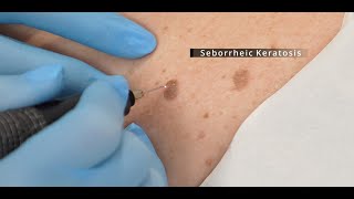 Plasma Pen  Seborrheic Keratosis Español [upl. by Nohsreg515]