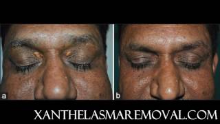 Xanthelasma removal at home without scarring the most time saving and cost effective solution [upl. by Tadeas]