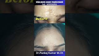 9 months after scar revision surgery Scar revision surgery  laser treatment  result after 9 month [upl. by Verile746]