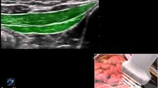 3D How To Ultrasound Guided Ilioinguinal and Iliohypogastric Nerve Block  SonoSite Ultrasound [upl. by Ahsieyn762]