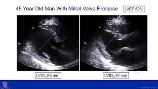 Mitral Valve ProlapseEcho Assessment [upl. by Jd]