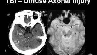 Diagnosing Brain Hemorrhages [upl. by Yleoj]