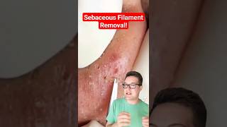 Major BLACKHEAD REMOVAL  Popping Sebaceous Filaments shorts [upl. by Forbes]