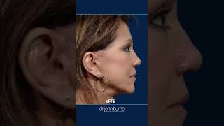 Facelift Before amp After  10 year Facelift Results [upl. by Farly126]