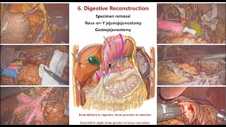 Laparoscopic Distal Gastrectomy With D2 Lymphadenectomy amp Intracorporal RouxenY Gastrojejunostomy [upl. by Aikemal]