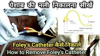 Urinary Catheter Remove कैसे करें  How to remove foleys Catheter  Foleys Catheter कैसे निकाले [upl. by Aynot]