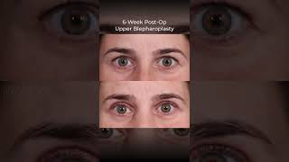 Upper Blepharoplasty Before amp After  Dr Paul Nassif [upl. by Cortie]