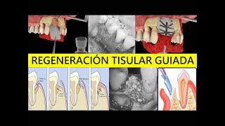 FUNDAMENTOS Y BASES QUIRÚRGICAS DE LA REGENERACIÓN TISULAR GUIADA RTG [upl. by Ahsitak61]