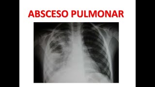 Diagnostico y tratamiento del Absceso Pulmonar MEDICINA INTERNA [upl. by Peskoff112]