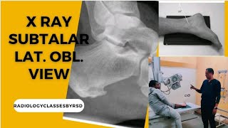 X RAY SUBTALAR JOINT LATERAL OBLIQUE VIEW radiologytechnical1221 RadiologyclassesbyRSD [upl. by Maggie]