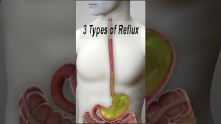 3 Types of Reflux GERD LPR nonacidic LPR shorts fauquierent [upl. by Ellehctim660]