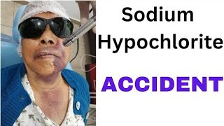 RCT complications  sodium hypochlorite accident and air emphysema [upl. by Aknayirp]