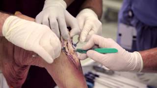 Patellar Tendon Graft [upl. by Salot]