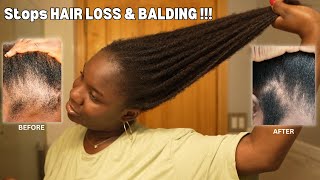 ❌എന്റെ മുടി വളരാൻ ഞാൻ ചെയ്ത കാര്യങ്ങൾ  Hair Growth tips Malayalam SimplyMyStyle Unni Haircare [upl. by Jeane]