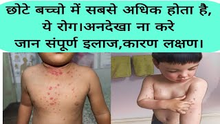 molluscum contagiosum disease causessymptoms and full treatmentछोटे बच्चो में अधिक होने बाला रोग। [upl. by Inglis]