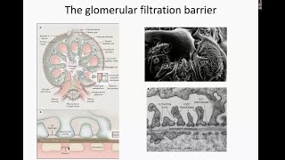 Membranous Nephropathy [upl. by Alaikim]