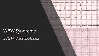 WolffParkinsonWhite WPW Syndrome ECG [upl. by Myles]