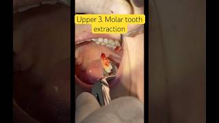 Upper 3 Molar tooth extraction [upl. by Remark]