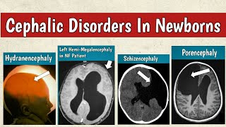 Cephalic Disorders In Newborns  Congenital Brain Malformations Radiology [upl. by Lauhsoj]