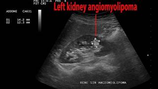 Rene sinistro angiomiolipoma  follow up [upl. by Ainez]