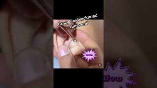 Ear Blackheads  Blackheads in Ear  Ear Blackheads This Week  Ear Cleaning [upl. by Aiello760]