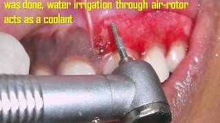 Gingival Depigmentation Procedure Using Diamond Bur Case By Dr Akash Akinwar [upl. by Noled]