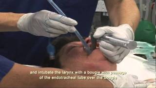 Intubation Extubation 47 [upl. by Rehprotsirhc]