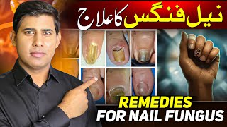 Cure Nail Fungus At Home in 7 Days│How to Get rid of Nail Fungus│Toenail Fungus│Nail Fungus Causes [upl. by Targett883]