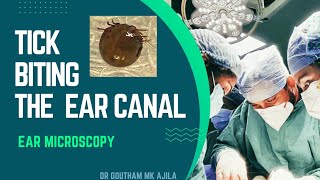 Tick Insect Biting the Ear Removal under Microscope Dr Goutham MK Ajila MSENT [upl. by Attenaej]