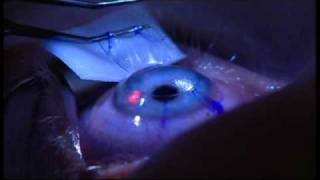 Laser Eye Surgery  The Patient Experience at London Vision Clinic on Harley St London [upl. by Imehon]