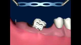 Video 3D sulluso delle Miniviti in Ortodonzia [upl. by Adnolehs]