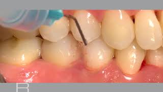 Nonsurgical treatment of periodontitis and periimplant mucositis [upl. by Hereld]