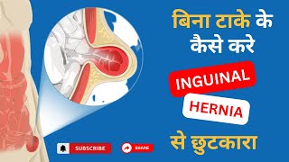 Inguinal Hernia  Signs And Symptoms Explain In Hindi  Dr Ankur Bansal [upl. by Palladin296]