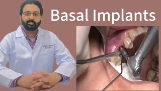 Mastering Basal Implants A Comprehensive Guide to Revolutionary Tooth Replacement Solutions [upl. by Angeli855]