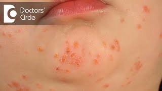 What is Impetigo amp its management  Dr Rasya Dixit [upl. by Jansson]