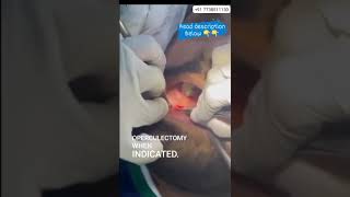 Operculectomy procedure [upl. by Jaela]