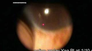 laser iridotomy for angle closure glaucoma [upl. by Marden]