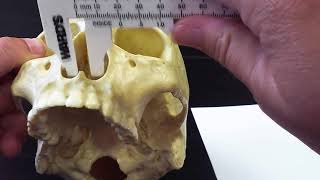 Measuring Nasal Index [upl. by Brandwein]