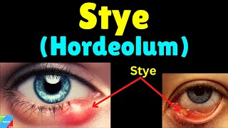 Stye Hordeolum Symptoms Causes Treatment amp Prevention – Sty [upl. by Adaiha377]