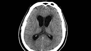 Hydrocephalus after SAH CT [upl. by Aisac]