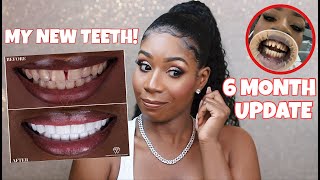 DO I REGRET GETTING VENEERS IN TURKEY THE TRUTH  6 Month Update QampA [upl. by Eux]